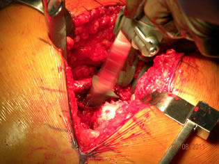 surgical-technique-perls-img2