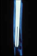 S-Rom grooved style stem progressive osteolysis