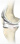 Total knee Arthroplasty - Joint Implant Surgery & Research Foundation
